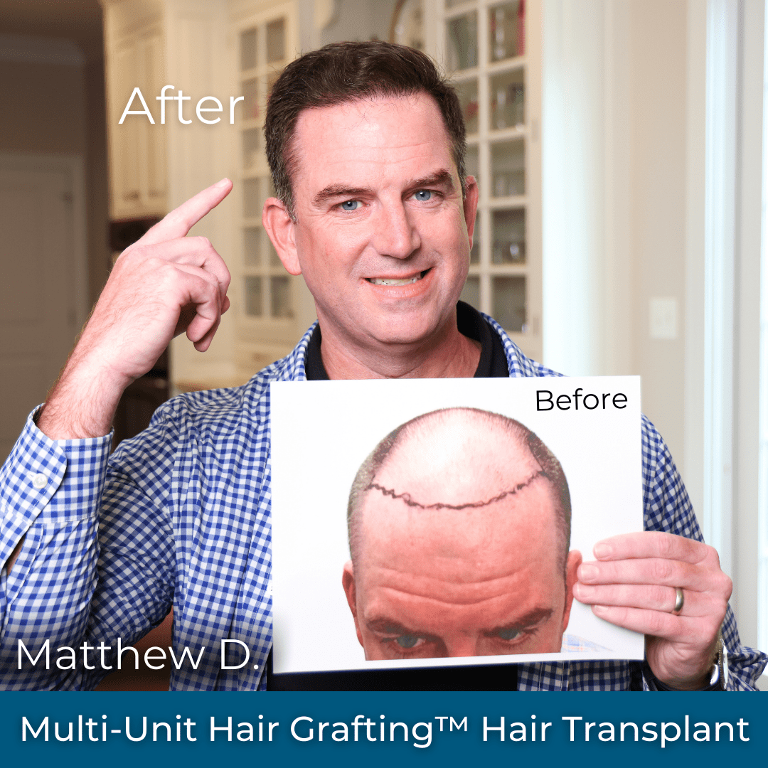 Hair Transplant Process