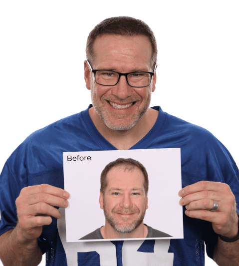 Hair Transplant Results Rick DeMulling