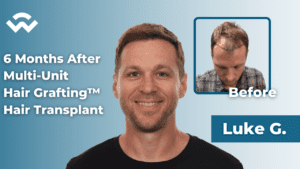 Client results six months after a hair transplant