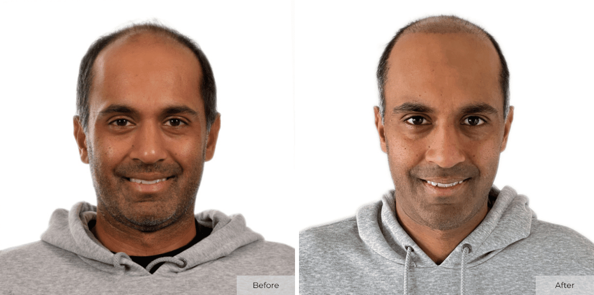 14 Days After Multi-Unit Hair Grafting™ - Before & After - Image 1