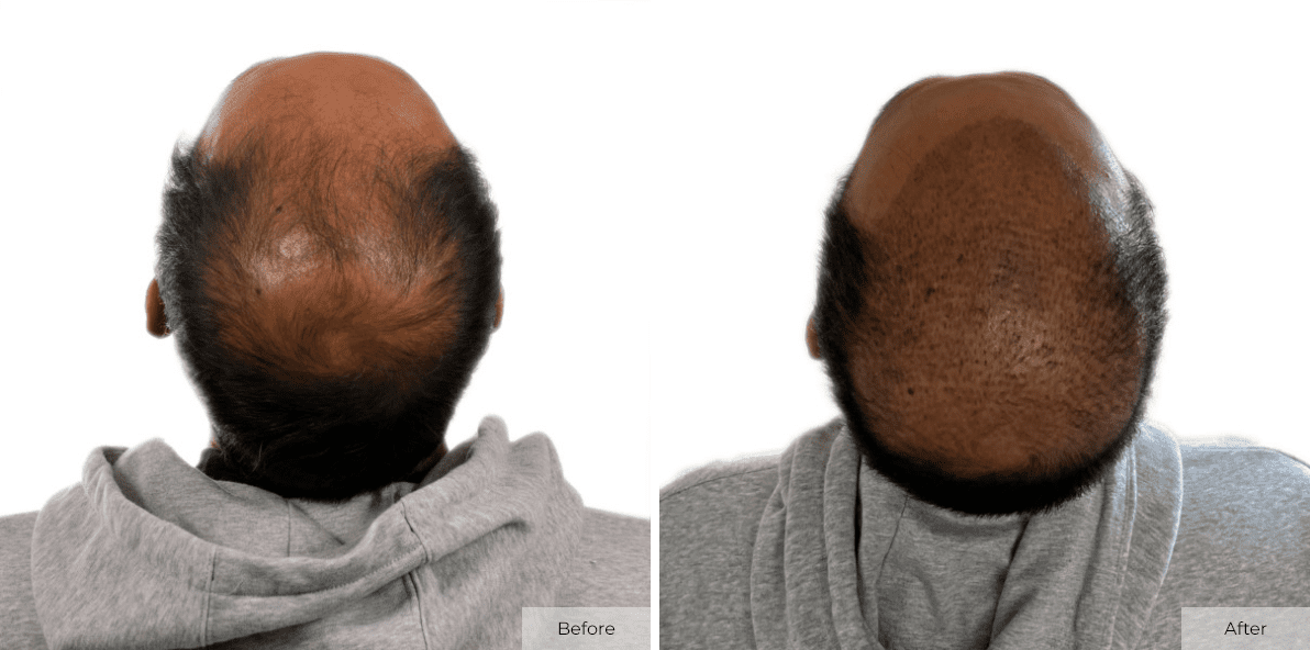 14 Days After Multi-Unit Hair Grafting™ - Before & After - Image 2
