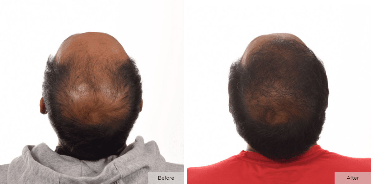8 Months After Multi-Unit Hair Grafting™ - Before & After - Image 2
