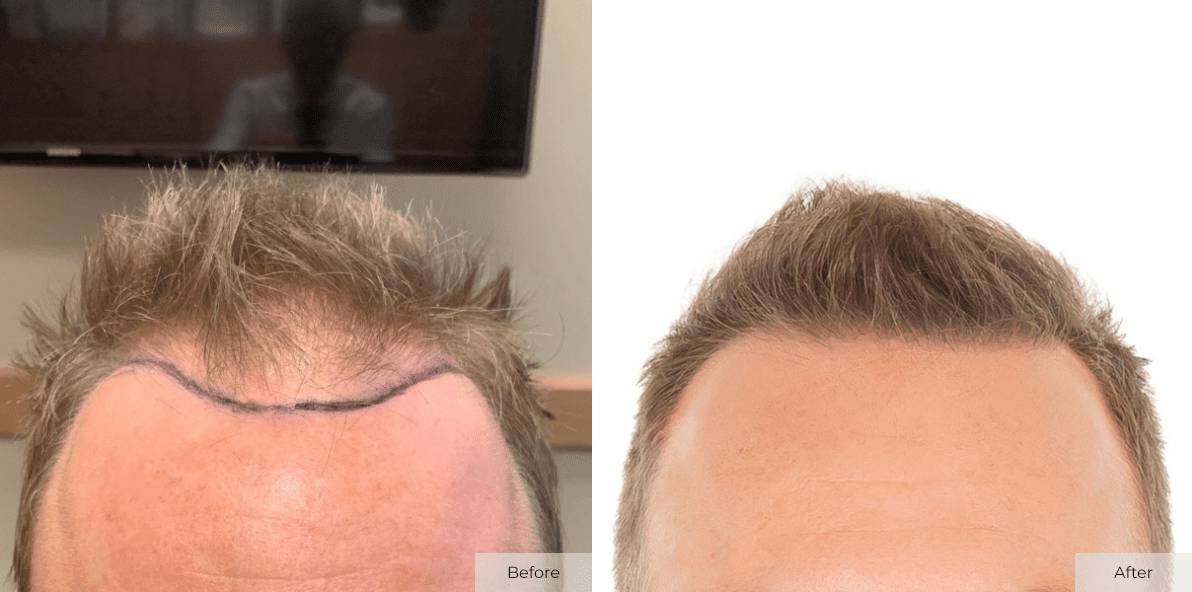 Crate 7 Months Post ARTAS FUE Hair Transplant Procedure - Before & After Image 2