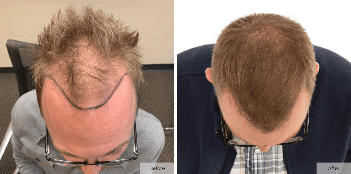 Crate 7 Months Post ARTAS FUE Hair Transplant Procedure - Before & After Image 3