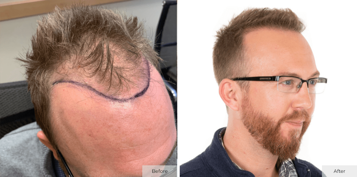 Crate 7 Months Post ARTAS FUE Hair Transplant Procedure - Before & After Image 4