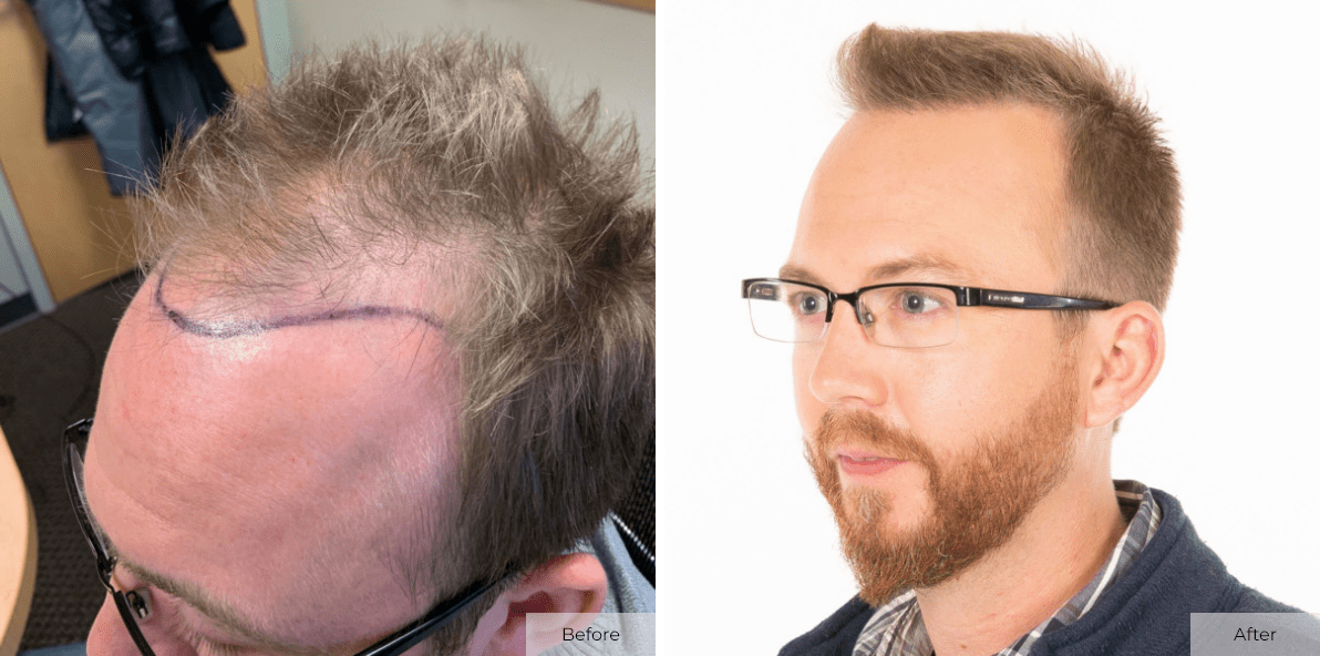 Crate 7 Months Post ARTAS FUE Hair Transplant Procedure - Before & After Image 6