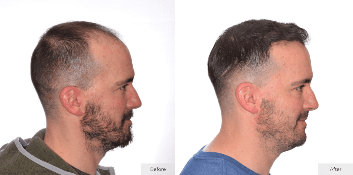 Joe Bergen - Before- Before & After - Image 5