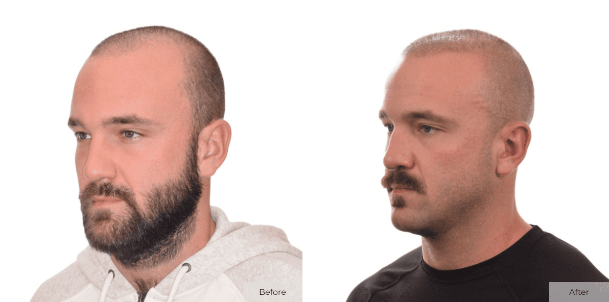 Kyler White - Before & After - Image 4