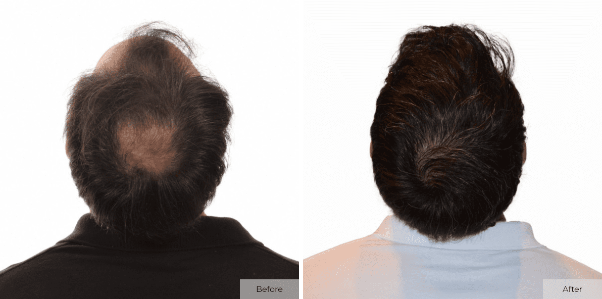 Multi-Unit Hair Grafting™ Hair Transplant Results - Before & After Image 1
