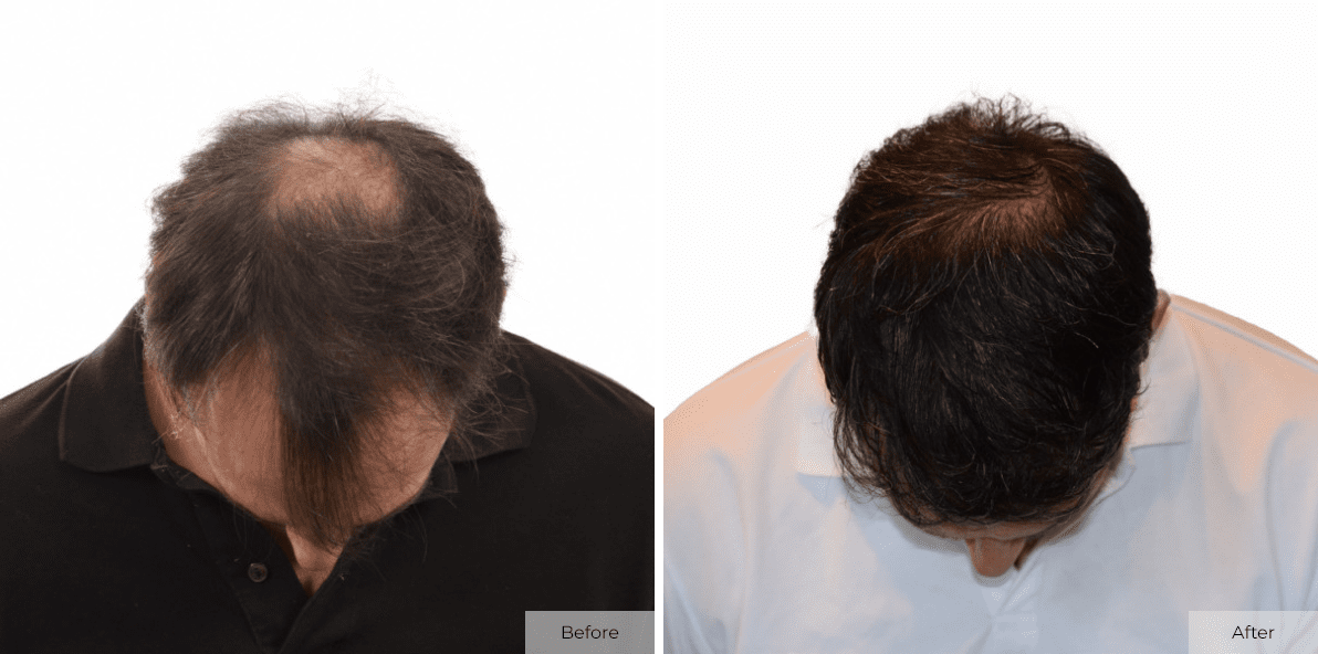 Multi-Unit Hair Grafting™ Hair Transplant Results - Before & After Image 2
