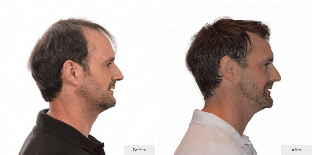 Multi-Unit Hair Grafting™ Hair Transplant Results - Before & After Image 3