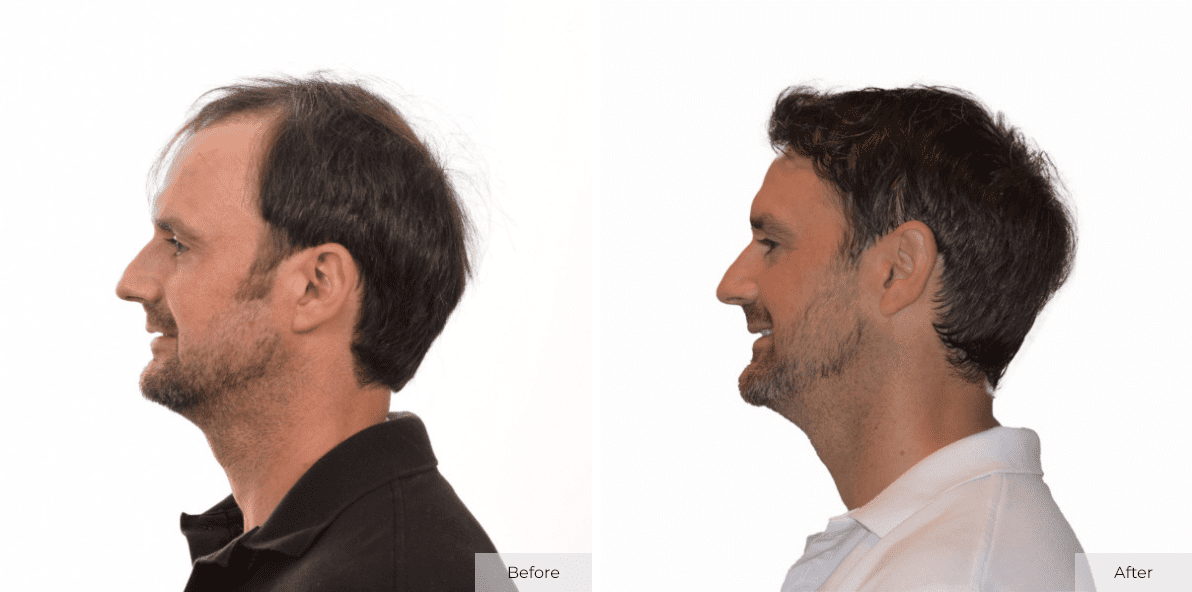 Multi-Unit Hair Grafting™ Hair Transplant Results - Before & After Image 4