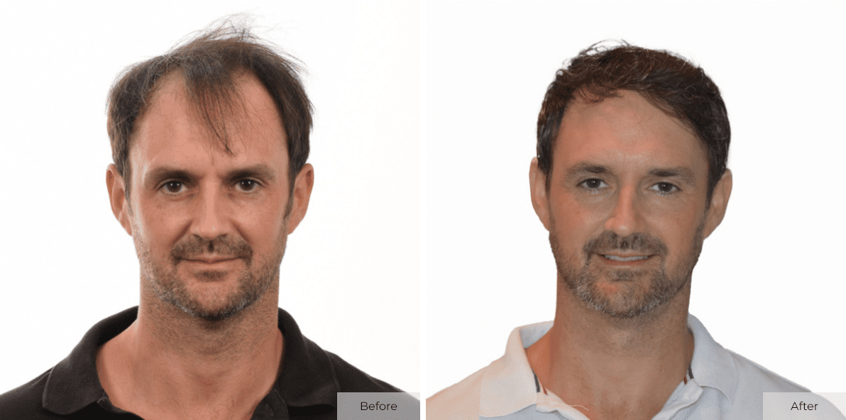 Multi-Unit Hair Grafting™ Hair Transplant Results - Before & After Image 5