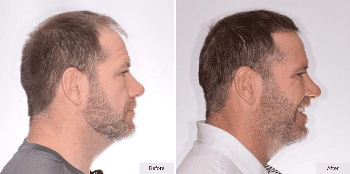 Rick DeMulling - Before & After - 4 month 3 – 1