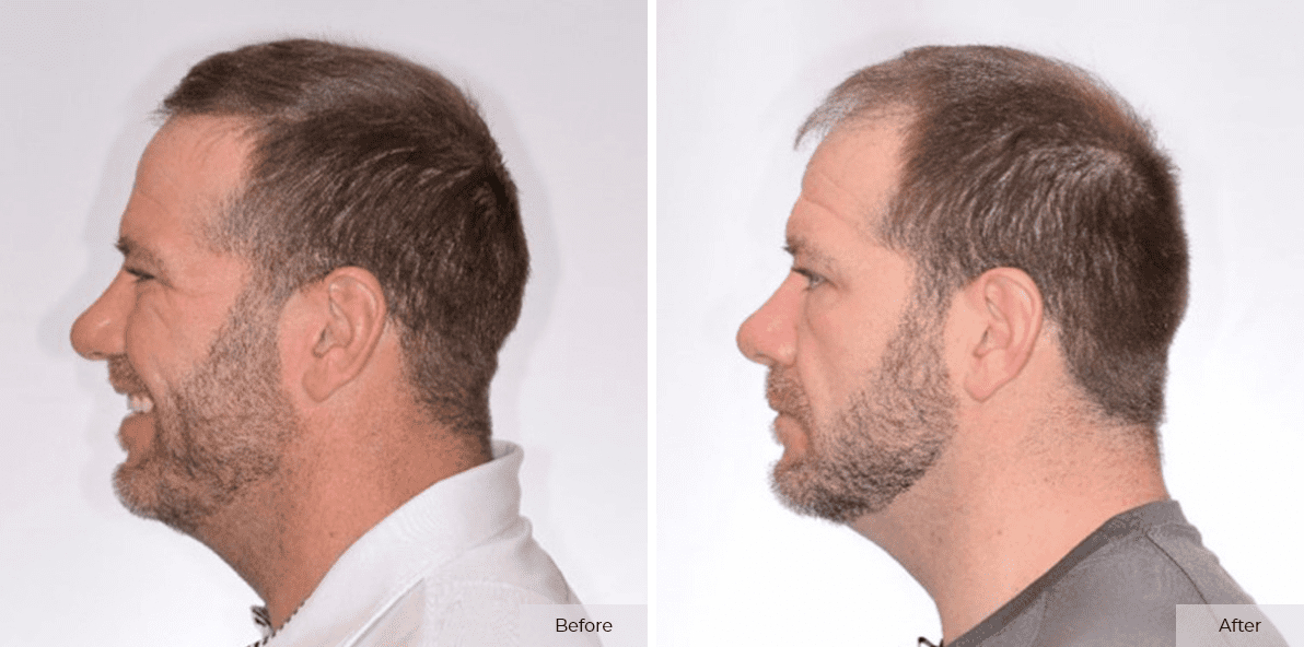 Rick DeMulling - Before & After - 4 month 4 – 1