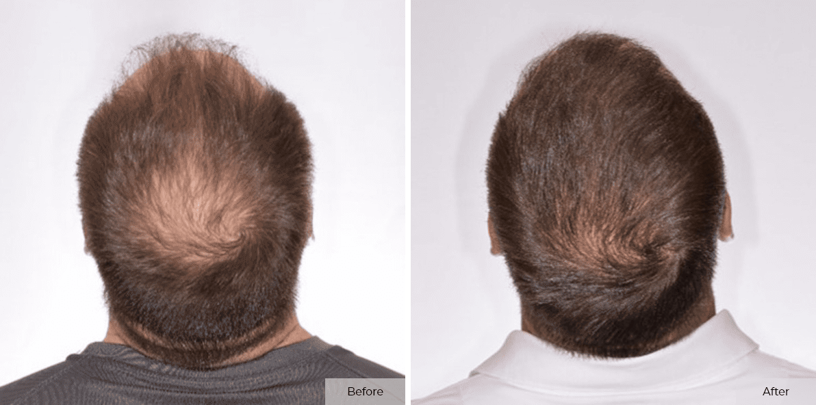 Rick DeMulling - Before & After - 4 month 5 – 1