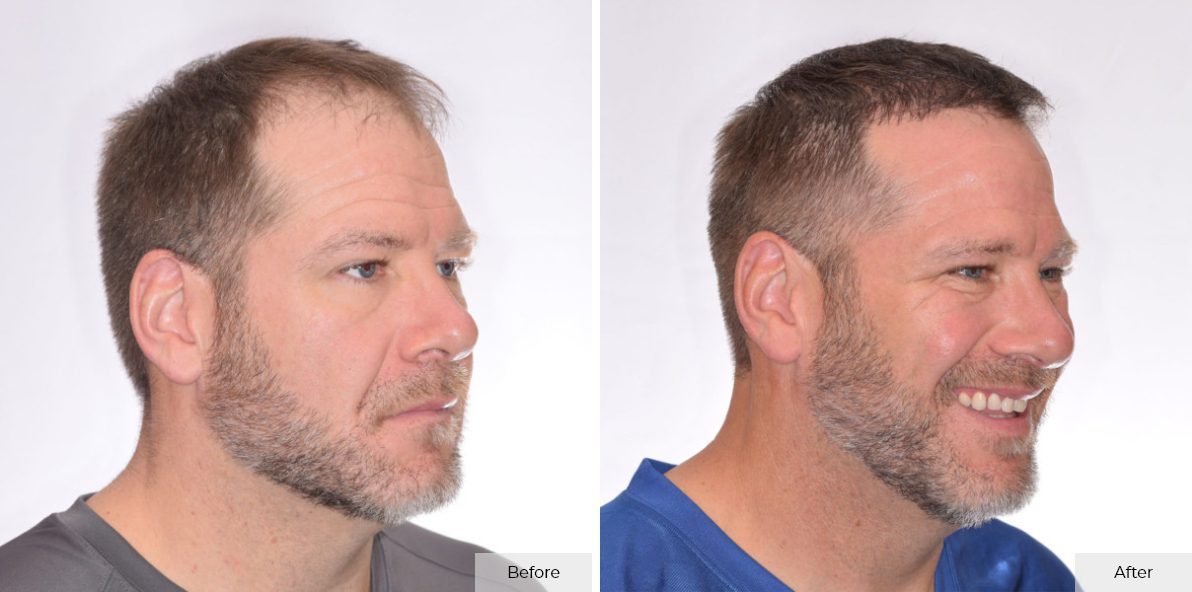 Rick DeMulling - Before & After - 6 month 1