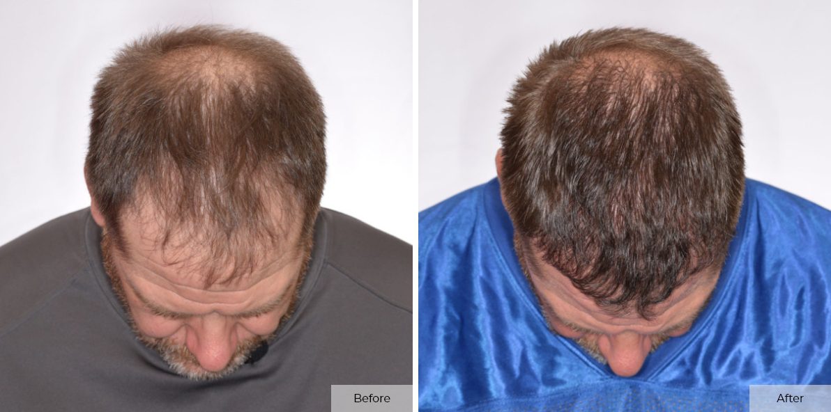 Rick DeMulling - Before & After - 6 month 3