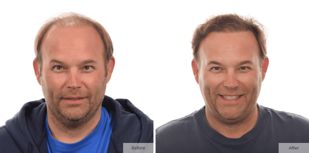 Steve Lindeman - Before & After - Image 1