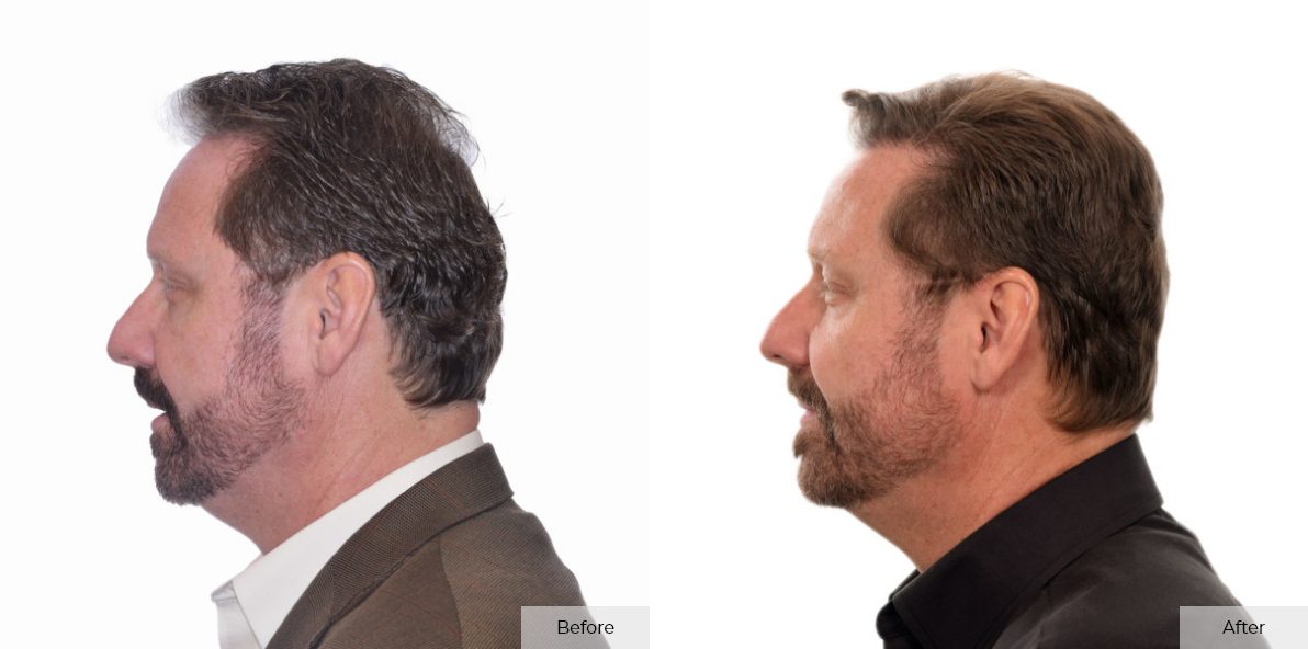 Jeff Brummett Before & After 3 – 14