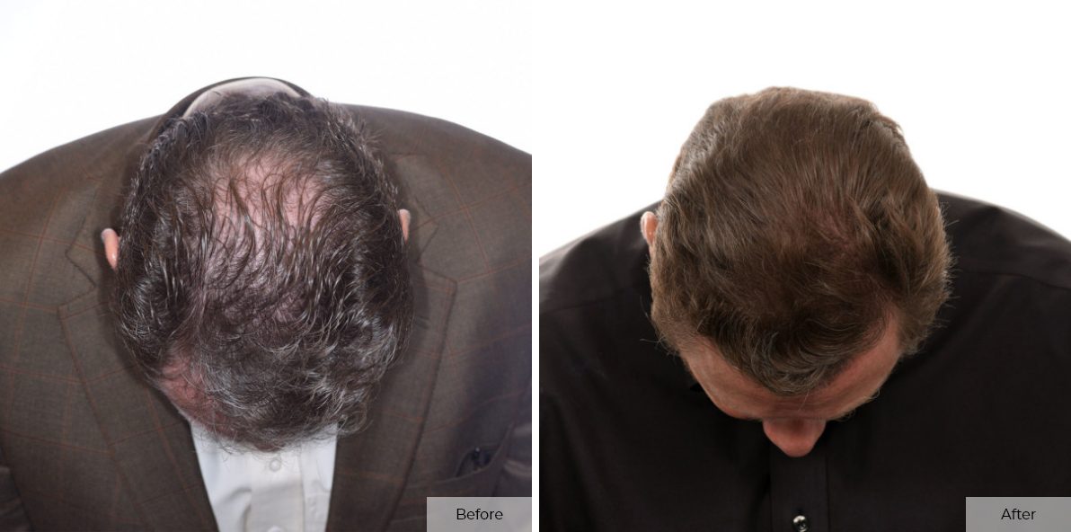Jeff Brummett Before & After 3 – 15
