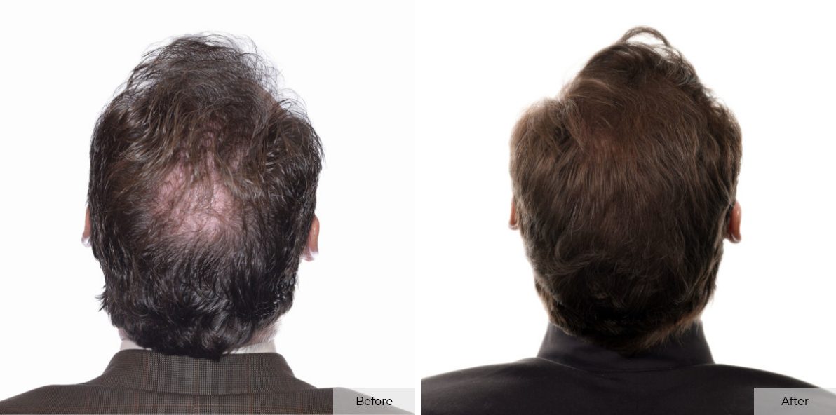 Jeff Brummett- Before & After 3 – 8