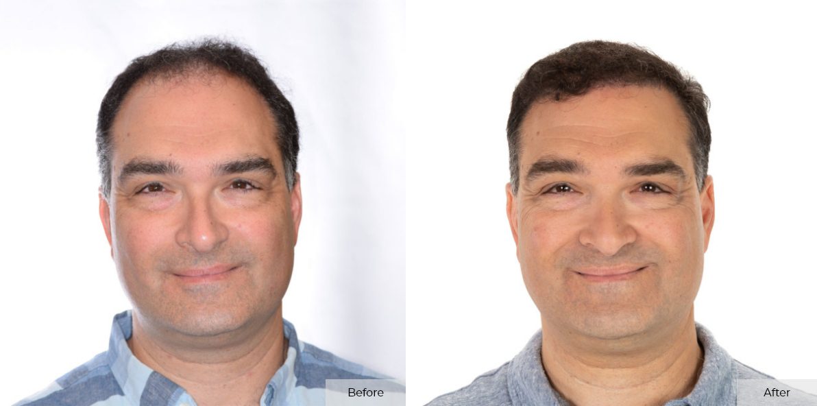 Pete Bitar - Before & After 1 – 2