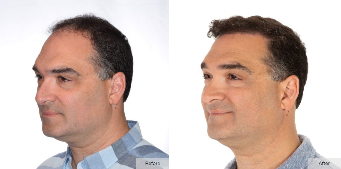 Pete Bitar - Before & After 3 – 2