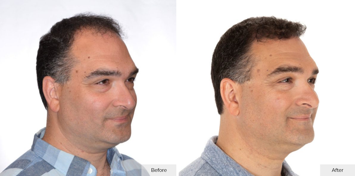 Pete Bitar - Before & After 4 – 2