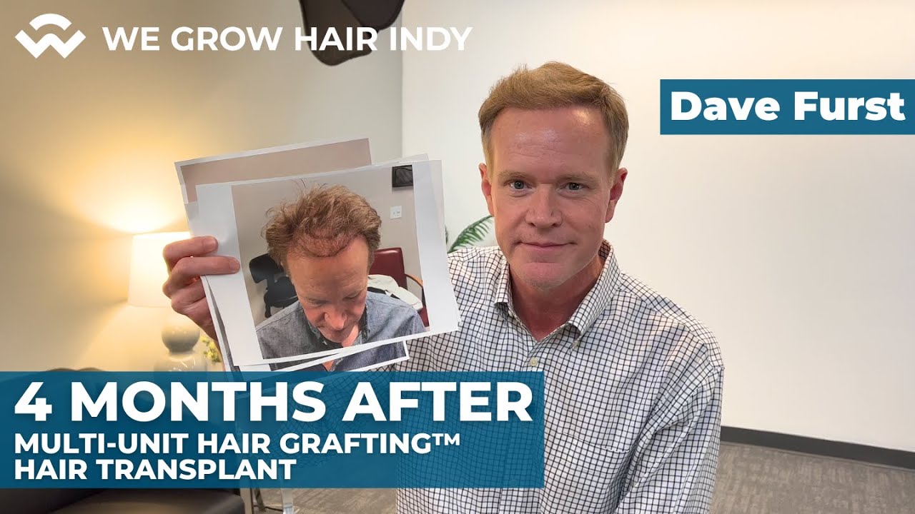 Dave Furst 4 Months After Multi-Unit Hair Grafting™ Hair Transplant!