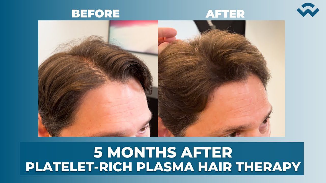Bob Jarosinski’s Hair Growth Results after 3 Enhanced Plasma Therapy Treatments!