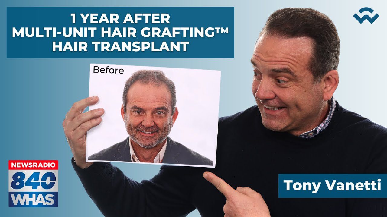Tony Vanetti’s Results 1 Year After Multi-Unit Hair Grafting™ Hair Transplant