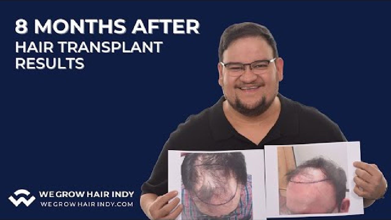8 Months After A Hair Transplant at We Grow Hair Indy - Jorge H.
