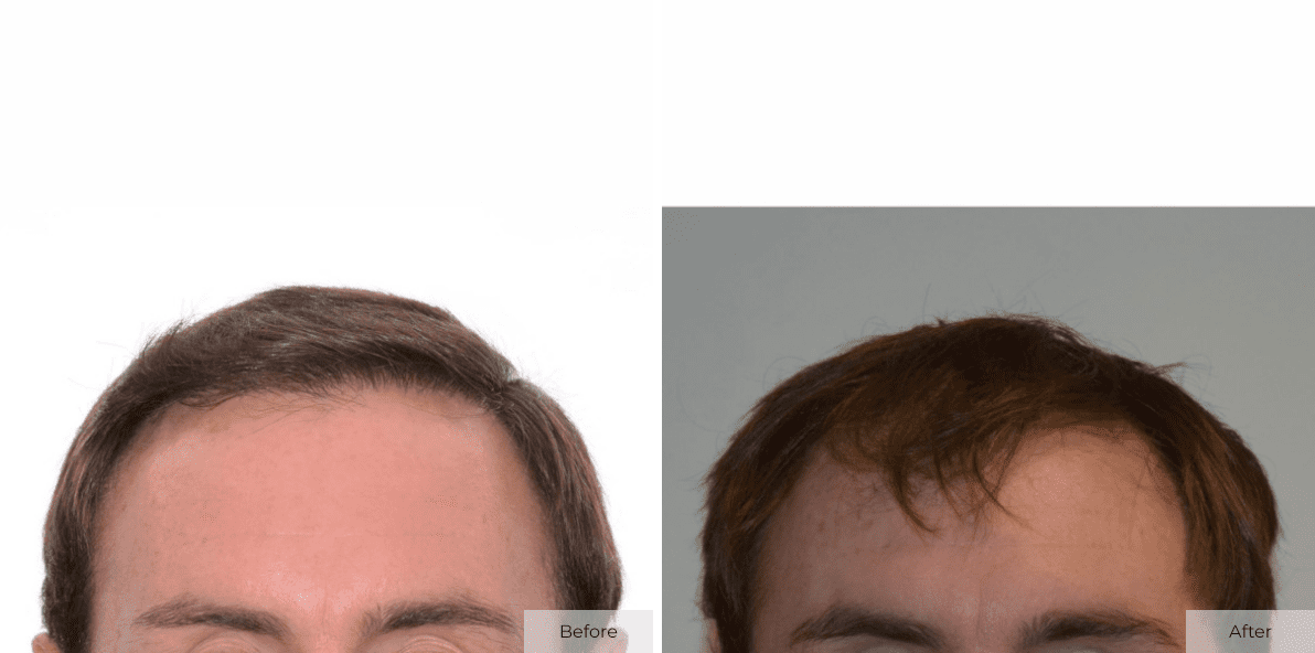 93 - Before & After 2 – Anonymous –2