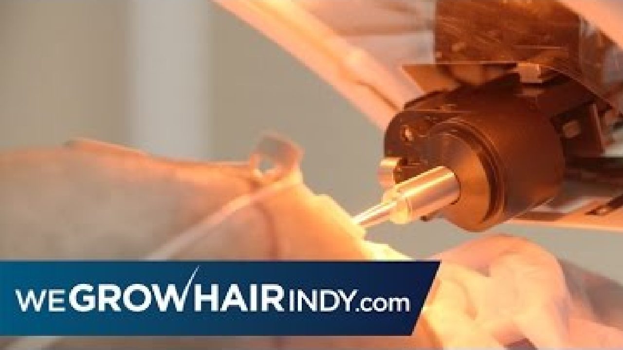 ARTAS Robotic FUE Hair Transplant Patient Experience