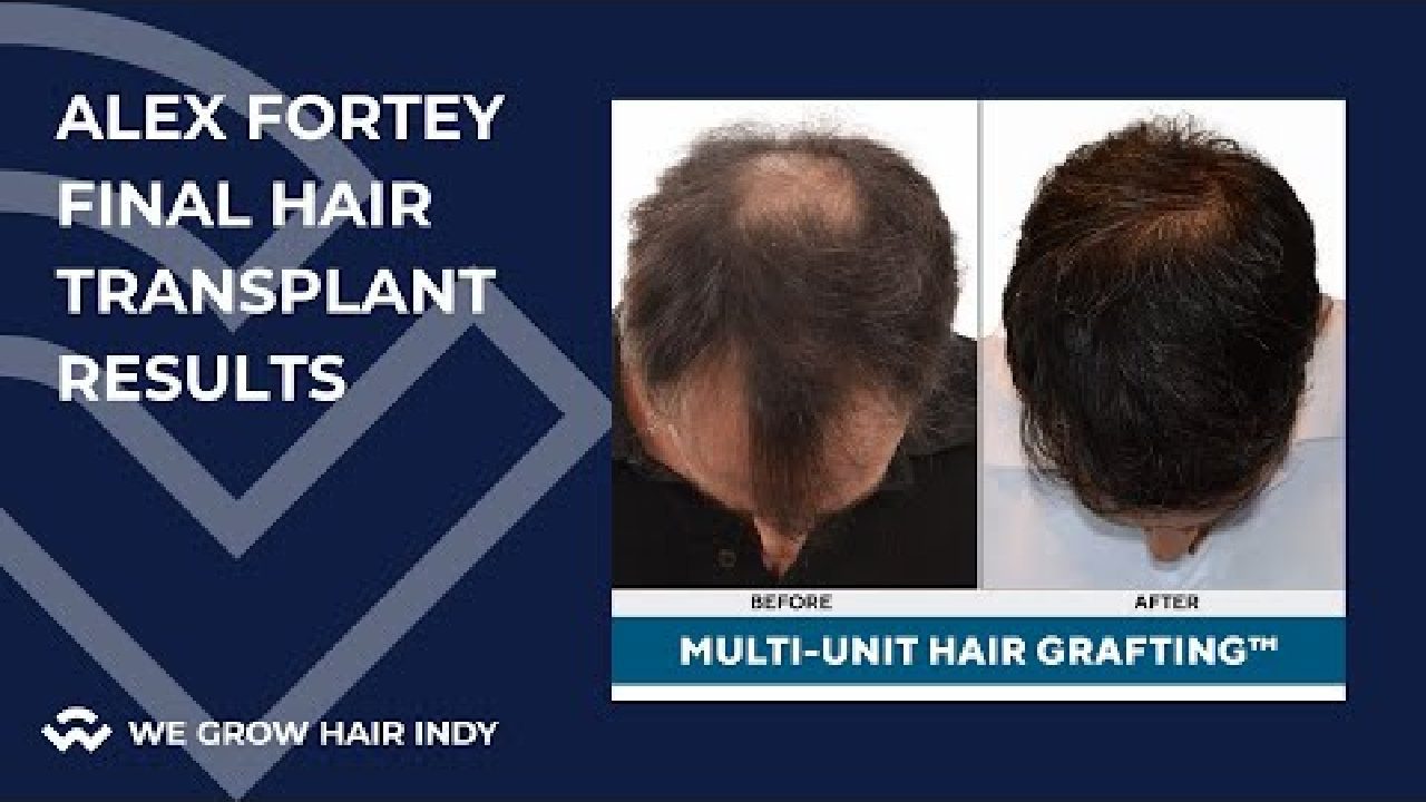 Alex Fortey Final Multi-Unit Hair Grafting™ Hair Transplant Results