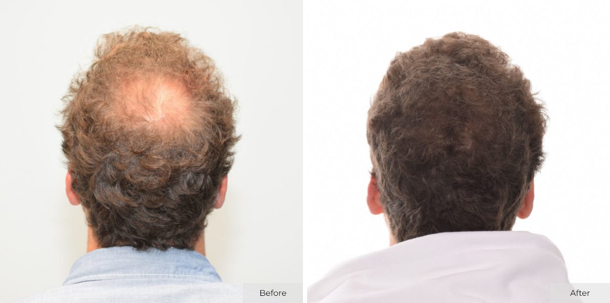 Anonymous male - Before & After - Image 1 – 2