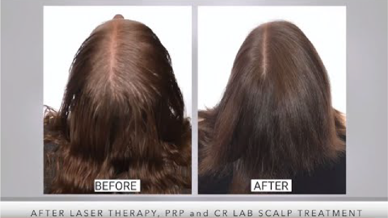 Proven Hair Restoration Treatment Solutions | WeGrowHairIndy Patient Amber
