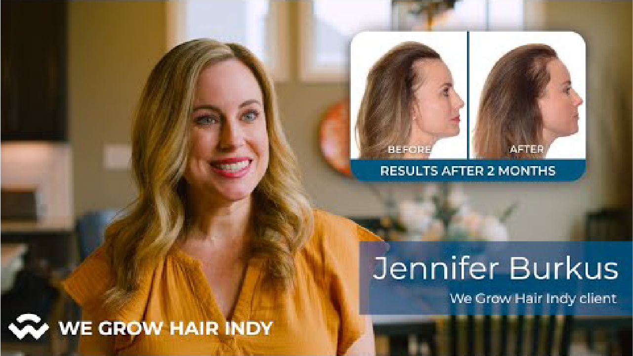 Jennifer Burkus Testimony – Non-Surgical Hair Treatments at We Grow Hair Indy
