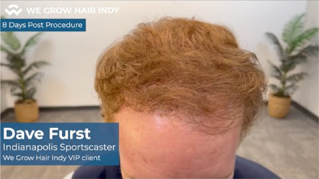 8 Days after Dave Furst’s Multi-Unit Hair Grafting™ Hair Transplant