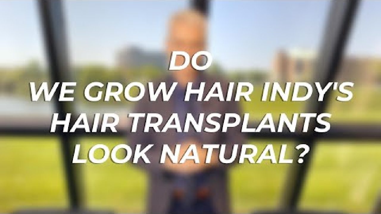 Do We Grow Hair Indy’s Hair Transplants Look Natural?