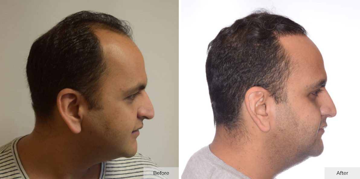 Faisal Khan - Before & After 2 – 43