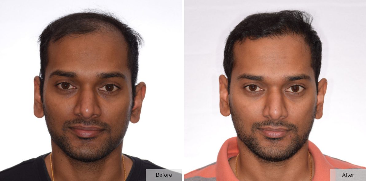 Gowtham Pathakamuri - Before & After 2 – 60
