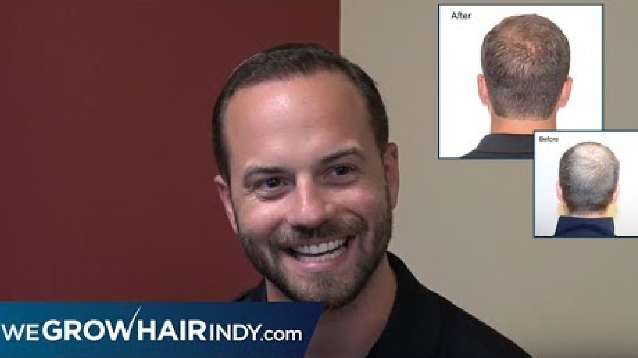 Hairline and Crown Hair Transplant Results with One Procedure