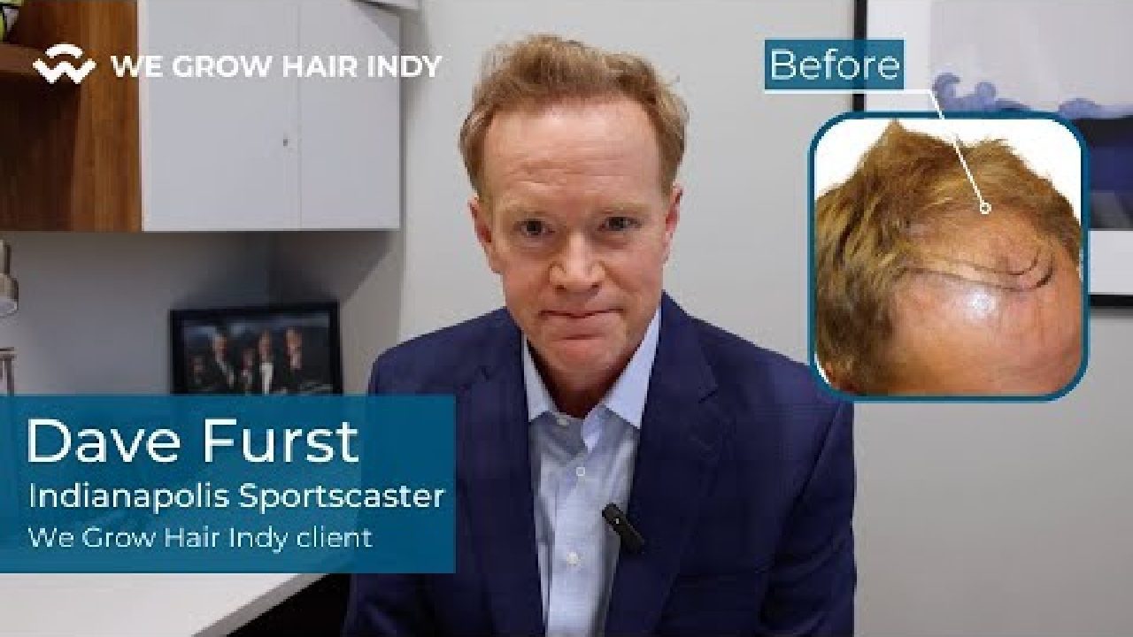 Introducing Dave Furst - We Grow Hair Indy's Newest VIP Hair Transplant Client