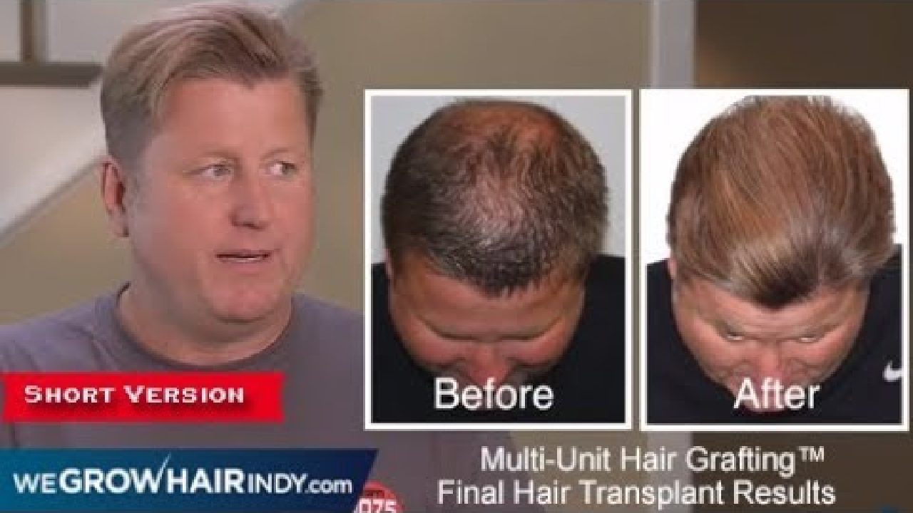JMV Hair Transplant Results (Short Version)
