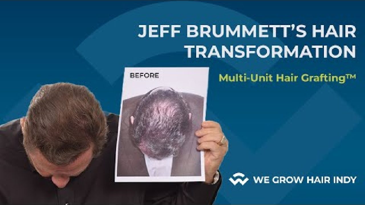 Jeff Brummett’s Hair Transplant Results | We Grow Hair Indy
