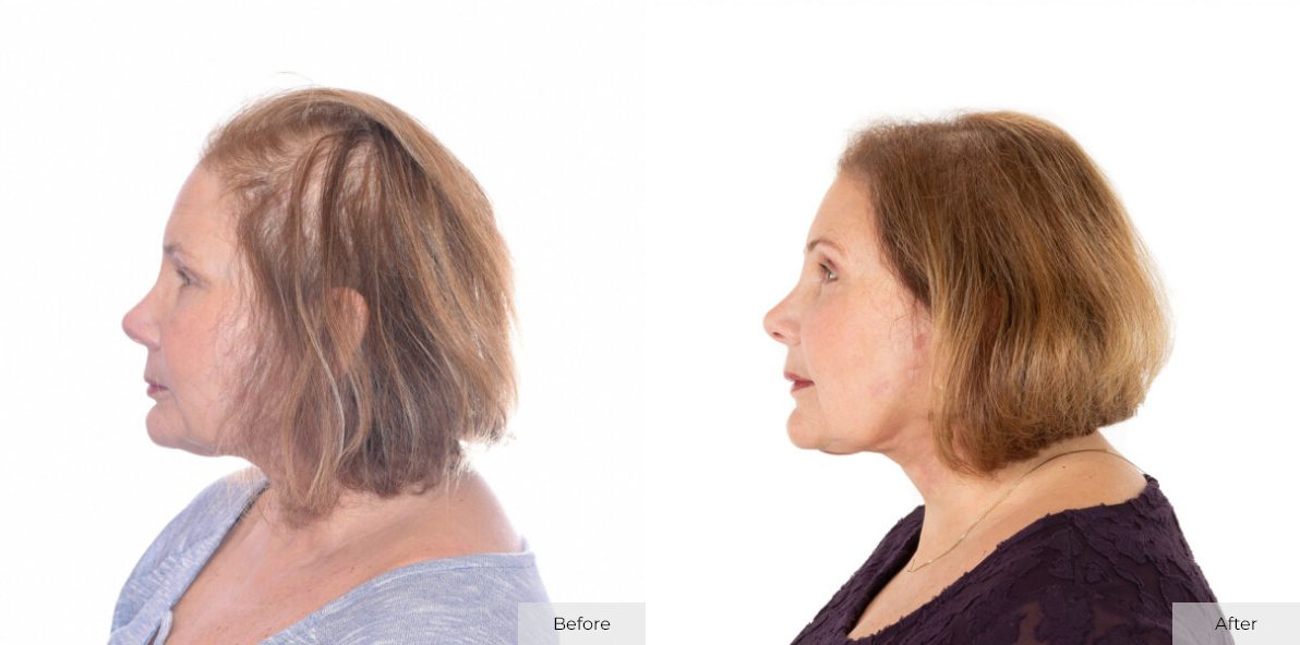 Marleen Signer - Before & After - Image 1 – 23