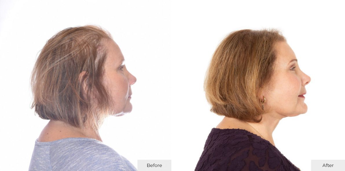 Marleen Signer - Before & After - Image 1 – 25