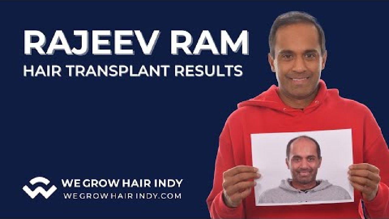 Rajeev Ram's Hair Transplant Results l We Grow Hair Indy